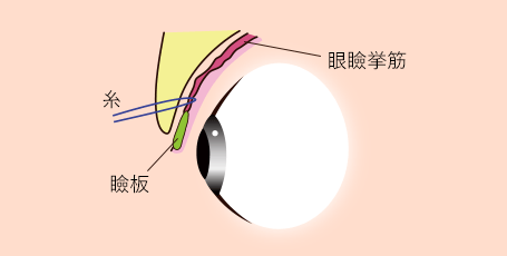 施術イメージ