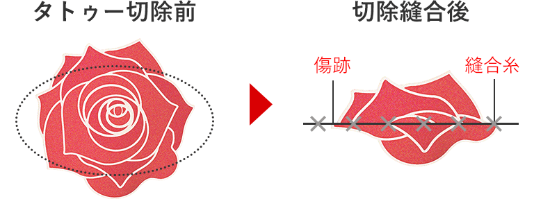 施術1回目-1